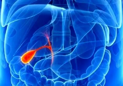سنگ کیسه صفرا چطور ایجاد می‌شود؟