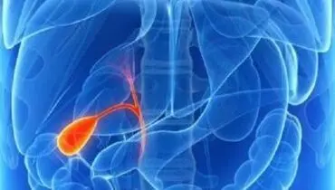چه کسانی مبتلا به سنگ صفرا می‌شوند؟
