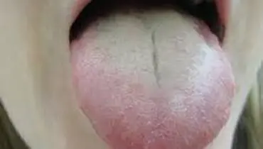 سفیدی زبان و دلایل شایع آن
