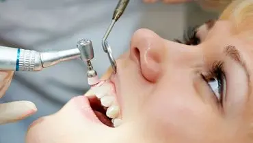 آیا جرم گیری، دندانهایتان را لق می‌کند؟