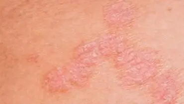 آلودگی هوا چه آسیبی به «پوست» می‌زند؟