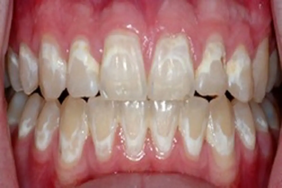 چه عواملی موجب تغییر رنگ دندان‌ها می‌شود؟