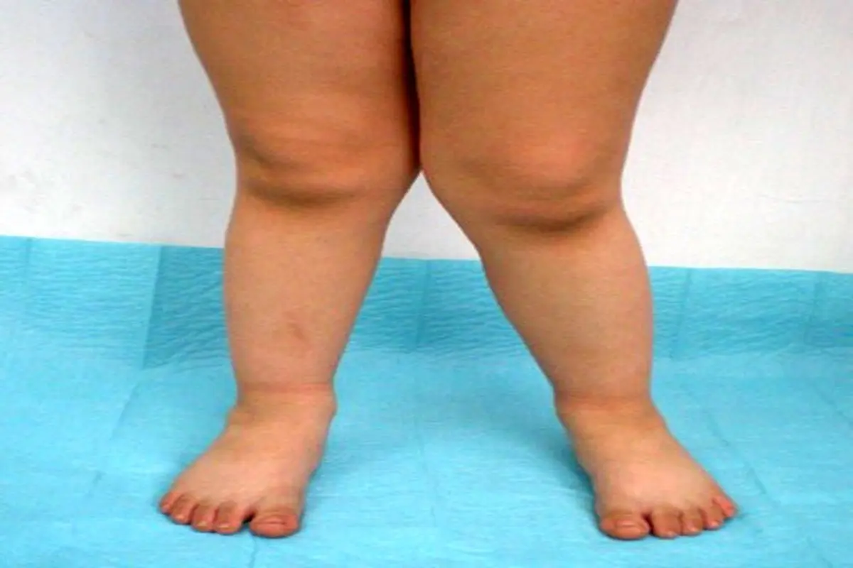 پای ضربدری در کودکان، علل، عوارض و راه‌های درمان زانوی ضربدری