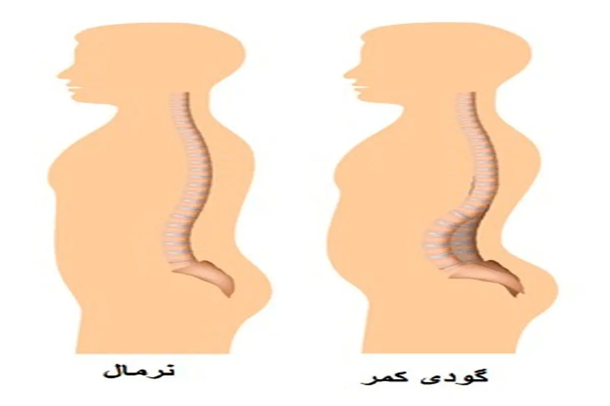 گودی کمر (لوردوز) , قوس غیر طبیعی و زیاد کمر به داخل