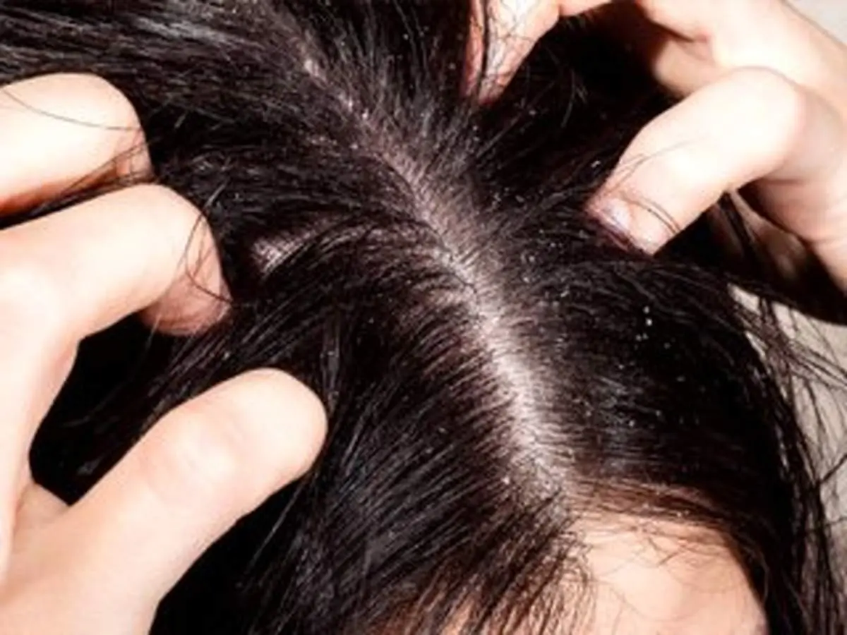 چگونه از چرب شدن موها جلوگیری کنیم؟
