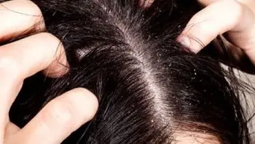 چگونه از چرب شدن مو‌ها جلوگیری کنیم؟