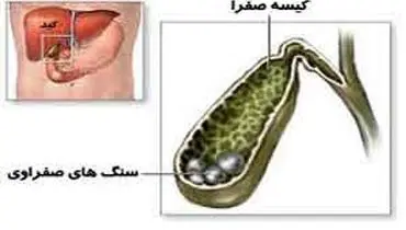 اصلی‌ترین عامل سنگ صفرا چیست