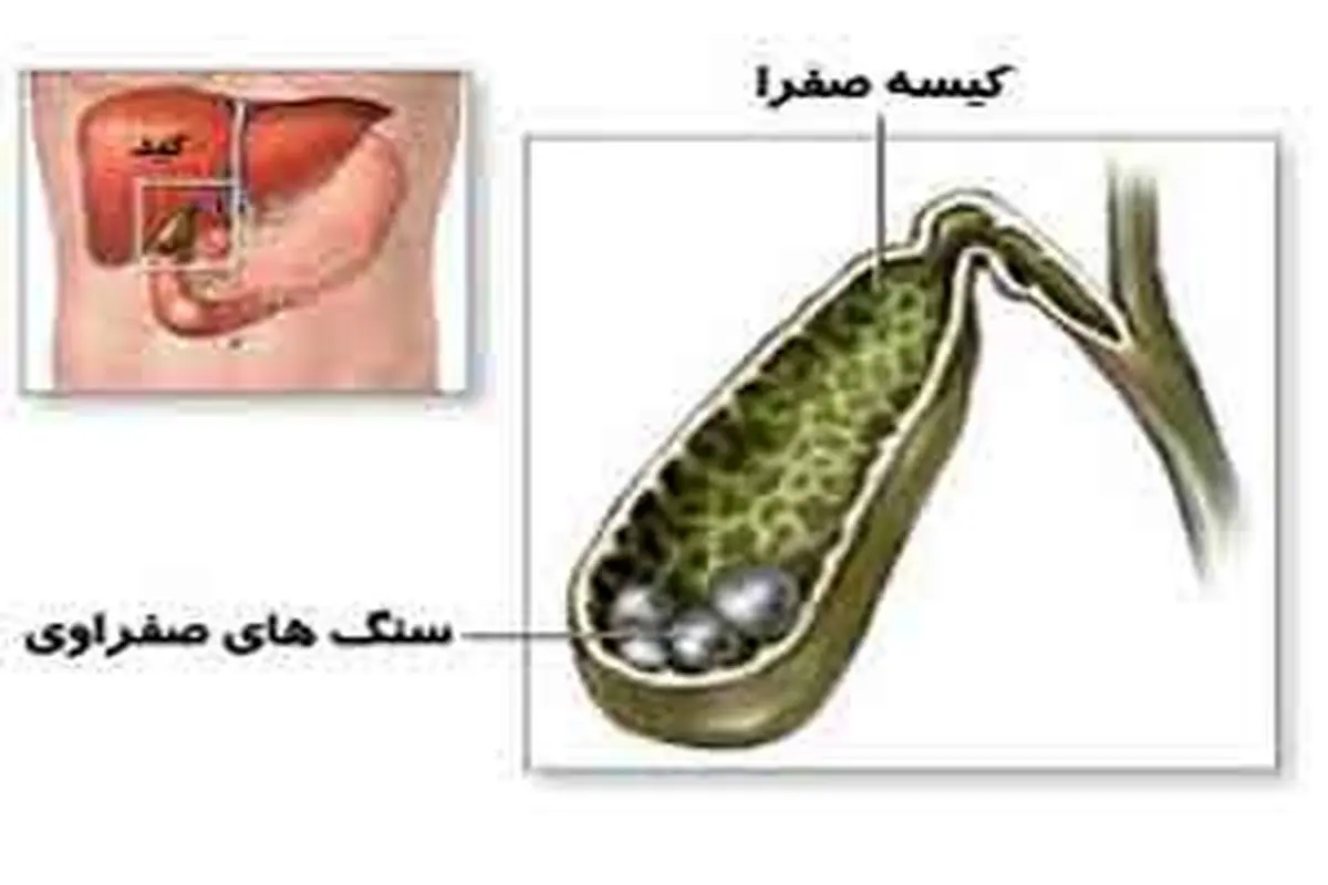 اصلی‌ترین عامل سنگ صفرا چیست