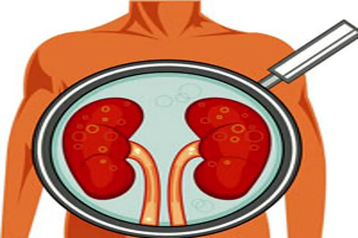 چرا دچار سنگ کلیه میشویم؟