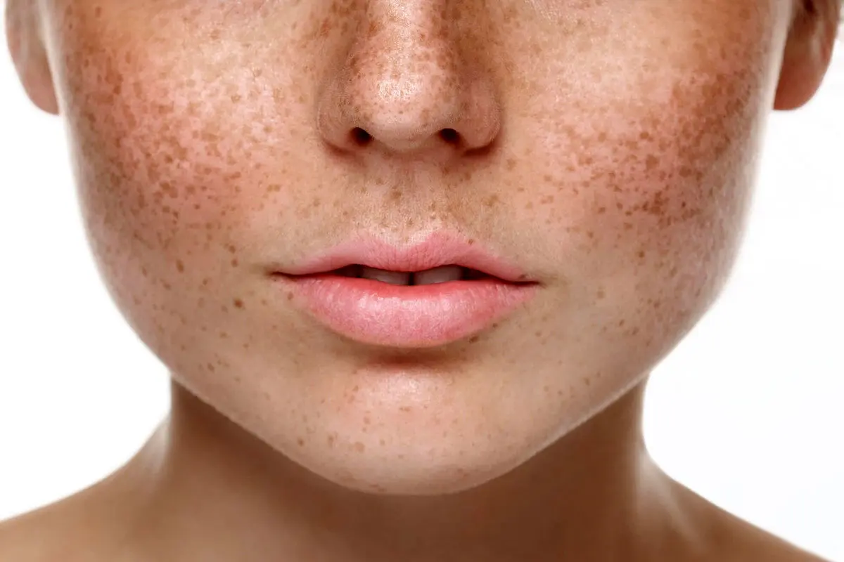 عوامل ایجاد لک‌های پوستی را بشناسید