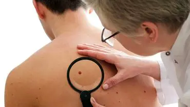 عامل سرطان پوست را بشناسید