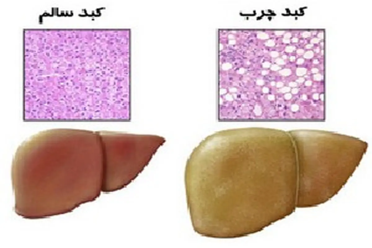 مشکلات کبد چرب در رژیم غذایی