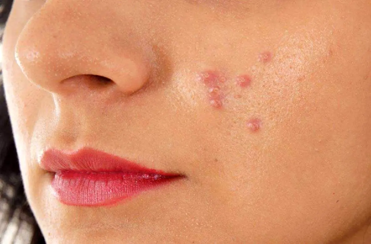 جوش زدن هر ناحیه از صورت نشانه چه بیماری است؟