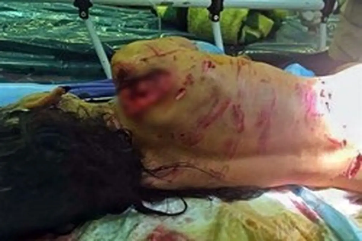 جزئیات حمله سگ به دختربچه پاکستانی