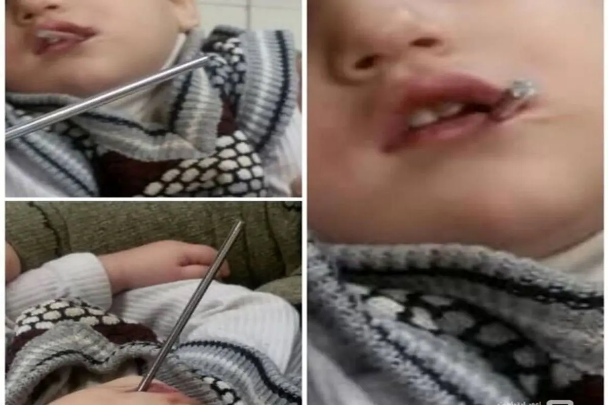 فرو رفتن میله در دهان کودک ۲ ساله+عکس