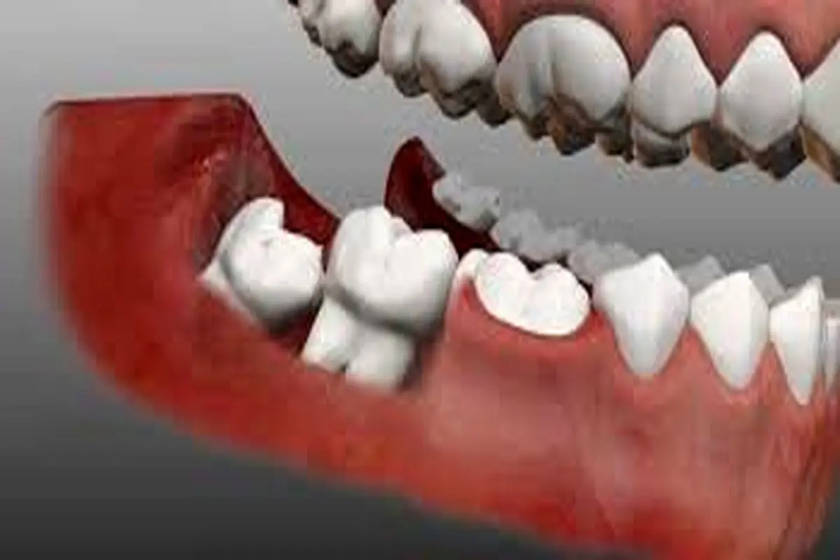 برای درمان پوسیدگی دندان در خانه این ۵ روش را امتحان کنید