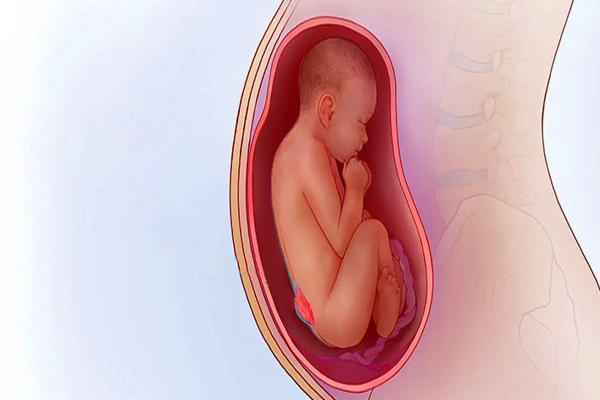 اسپینا بیفیدای جنین چیست و چگونه درمان می‌شود؟