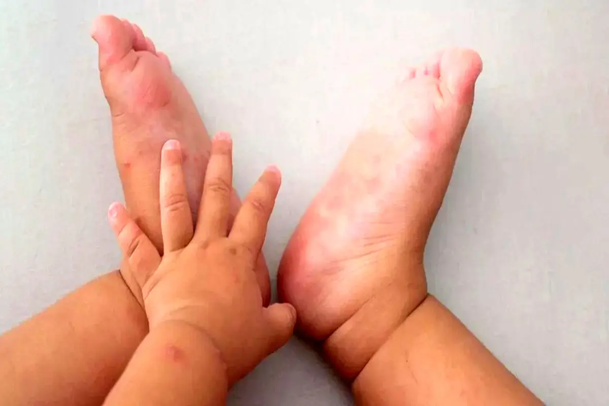 قارچ پوستی در کودکان چطور درمان می‌شود؟