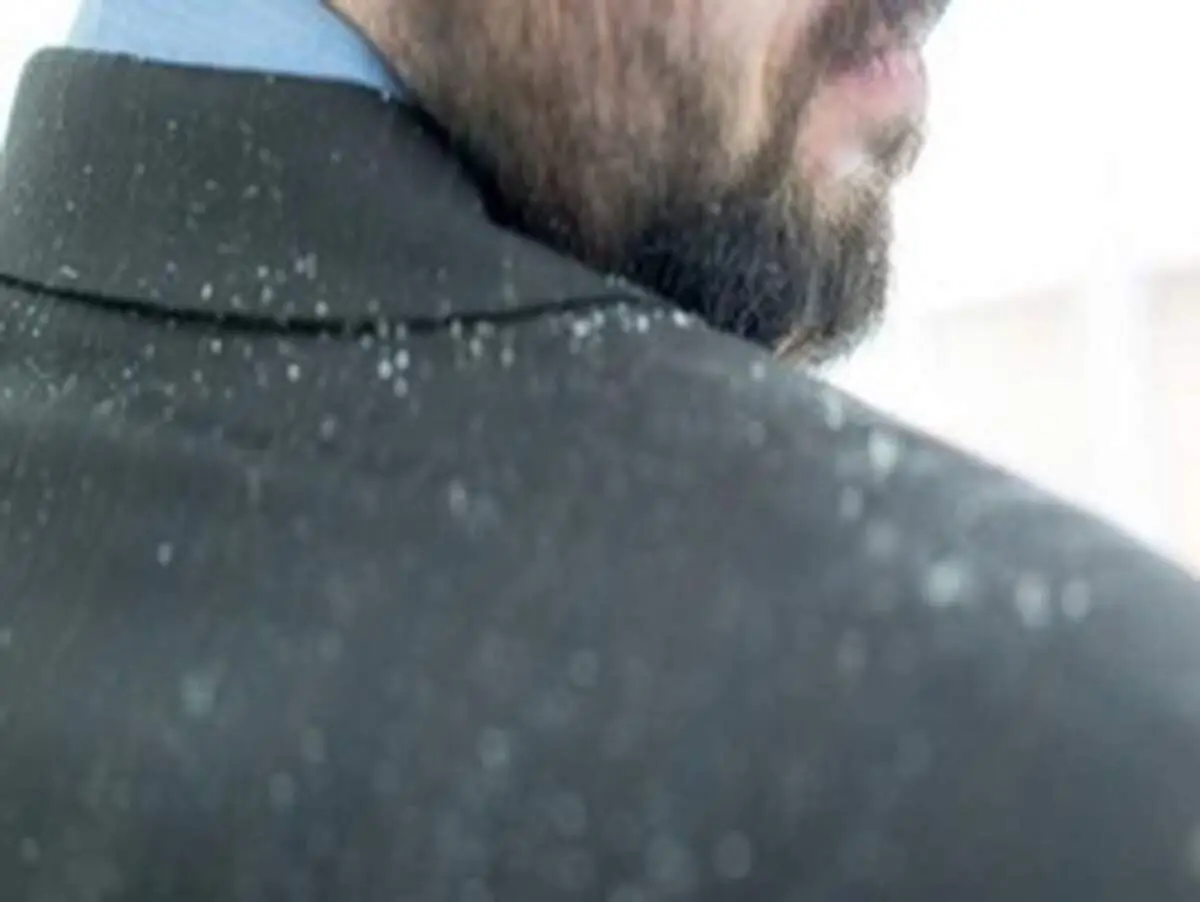 چگونه شوره سر را نابود کنیم؟