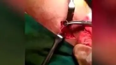 خارج کردن کرم زنده ۱۰ سانتی از صورت پسر جوان