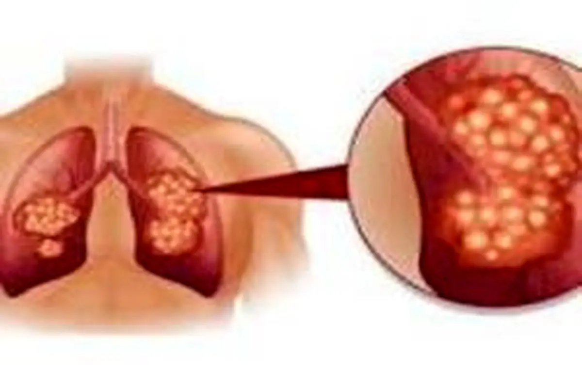 تشخیص سرطان ریه ازروی وضعیت ناخن‌ها