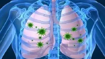 افزایش خطر انسداد مزمن ریوی در مبتلایان به HIV