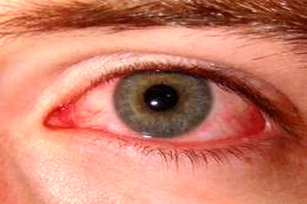 علل قرمزی چشم و راه درمان هرکدام