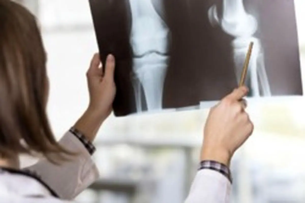 جراحی کاهش وزن ریسک شکستگی استخوان‌ها را افزایش می‌دهد
