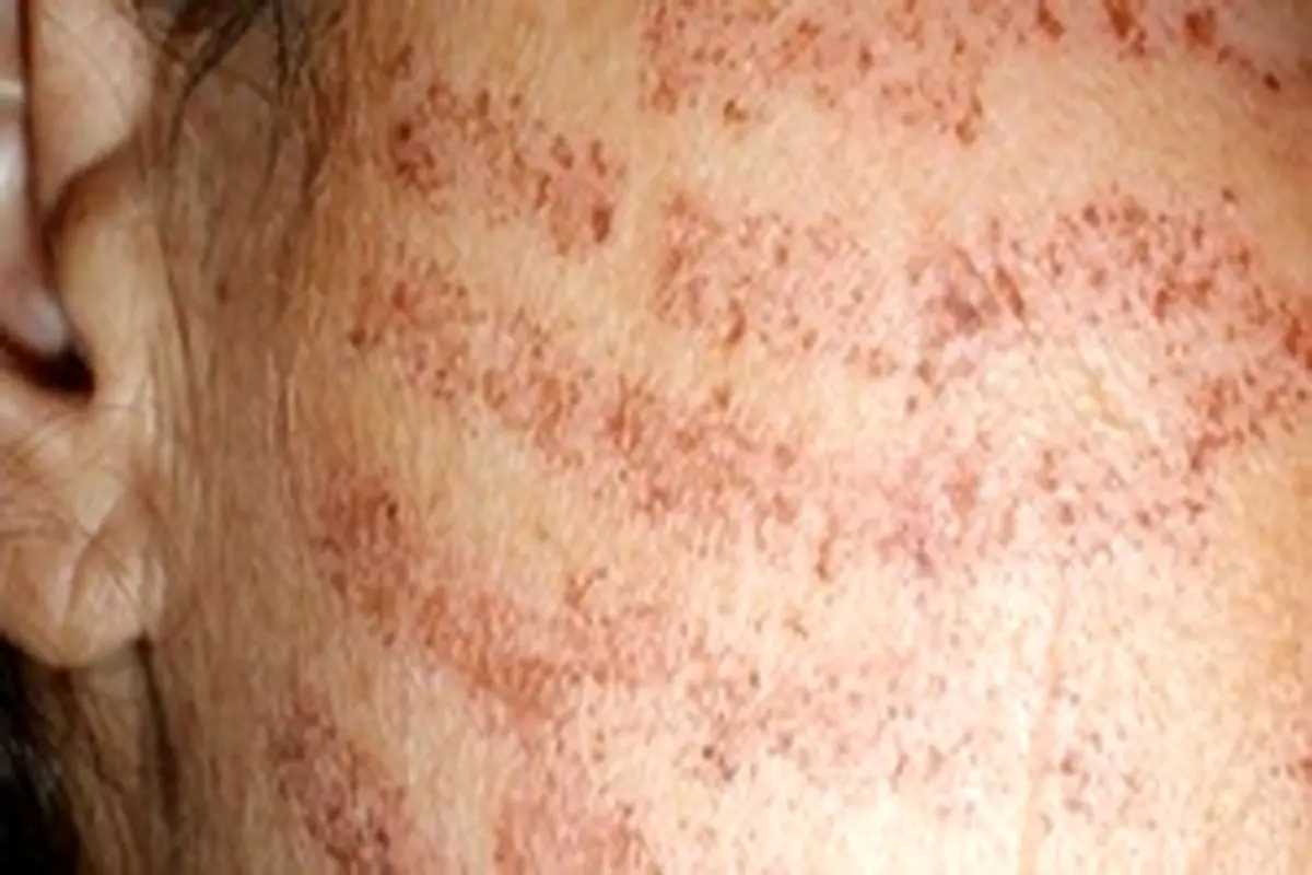 متخصصان: آسیب‌های پوستی از علائم احتمالی کرونا است