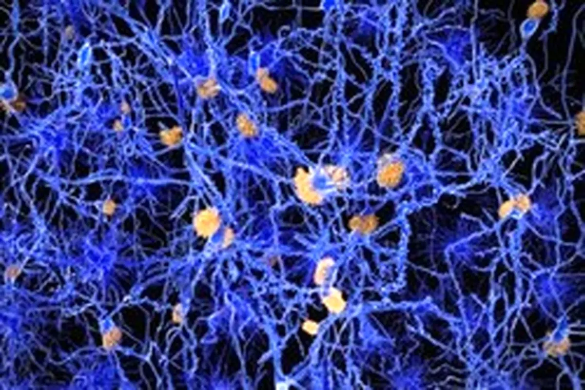 نشانه اولیه آلزایمر در مغز چیست