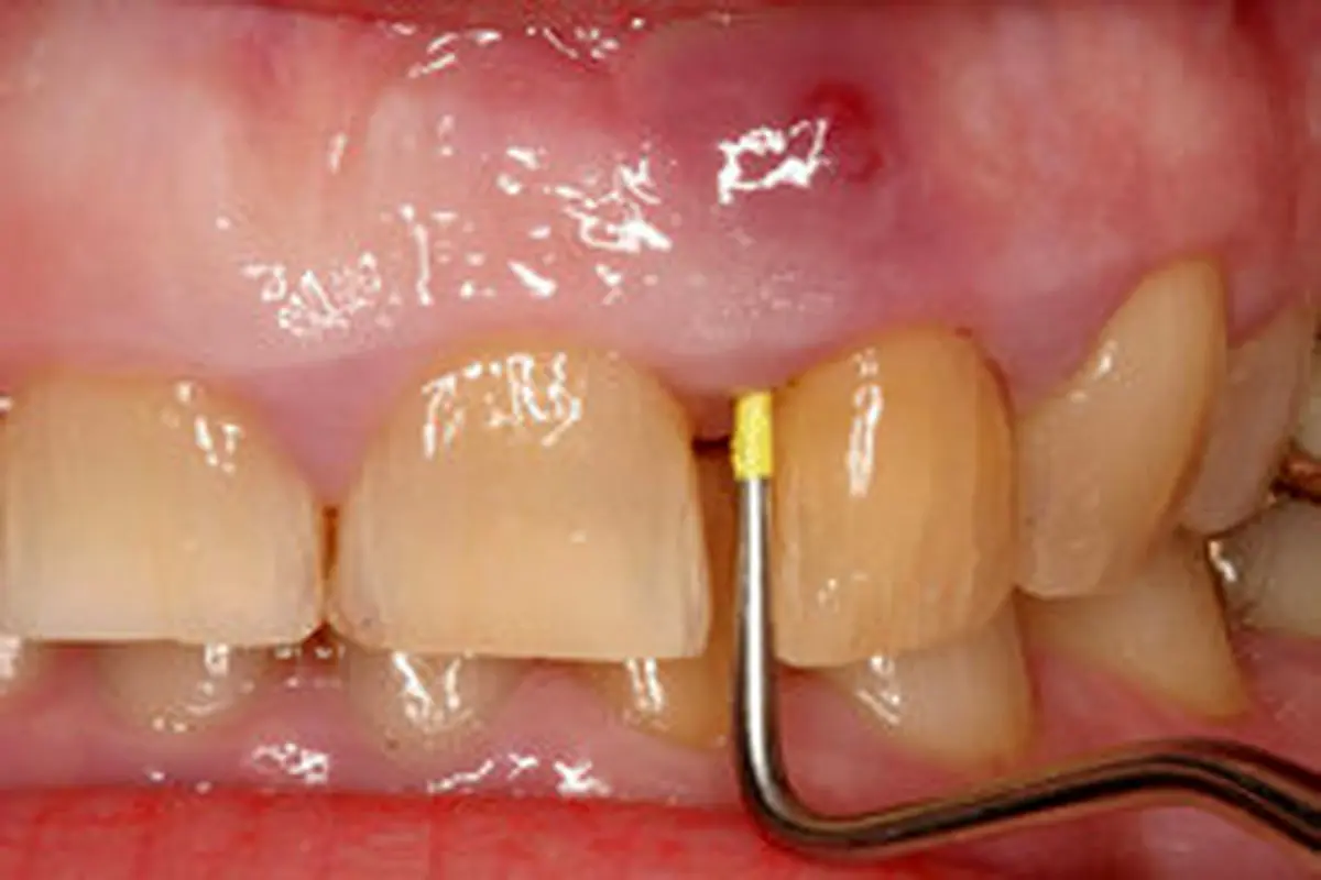 درمان عفونت دندان با روش‌های خانگی