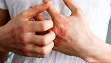 ویروس کرونا؛ برای رفع خارش پوست دست از چه کرمی استفاده کنیم؟