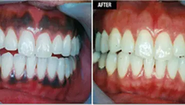 علل، درمان و پیشگیری از سیاه شدن لثه