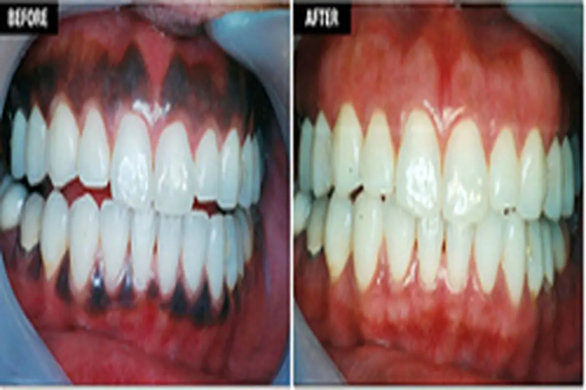 علل، درمان و پیشگیری از سیاه شدن لثه