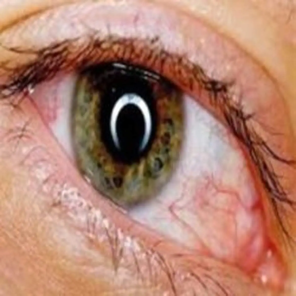 کدام تغییرات در چشم نشانه ابتلا به کروناست؟