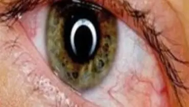 کدام تغییرات در چشم نشانه ابتلا به کروناست؟