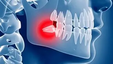 دندان عقل و دلایل درد گرفتن آن