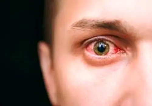 قرمزی چشم علت کدام بیماری است؟