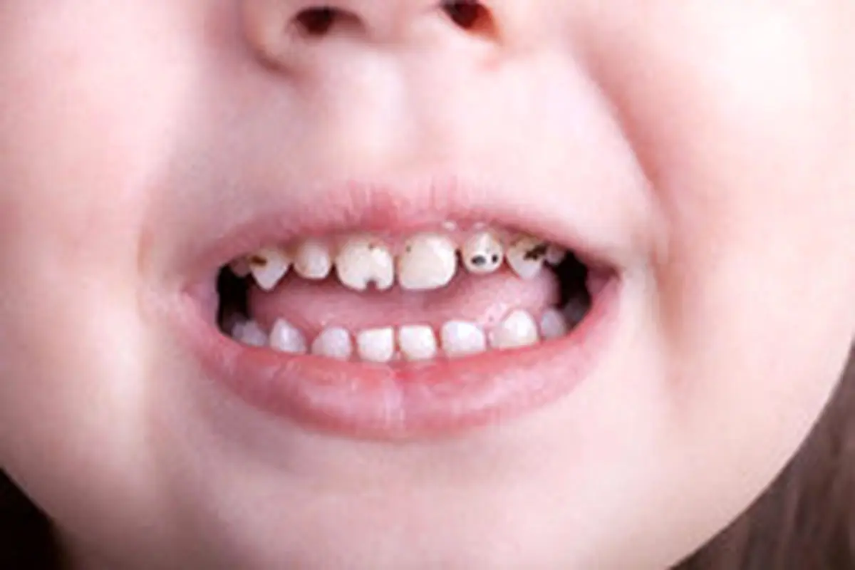 علت سیاه شدن دندان کودکان و راه‌های پیشگیری از آن
