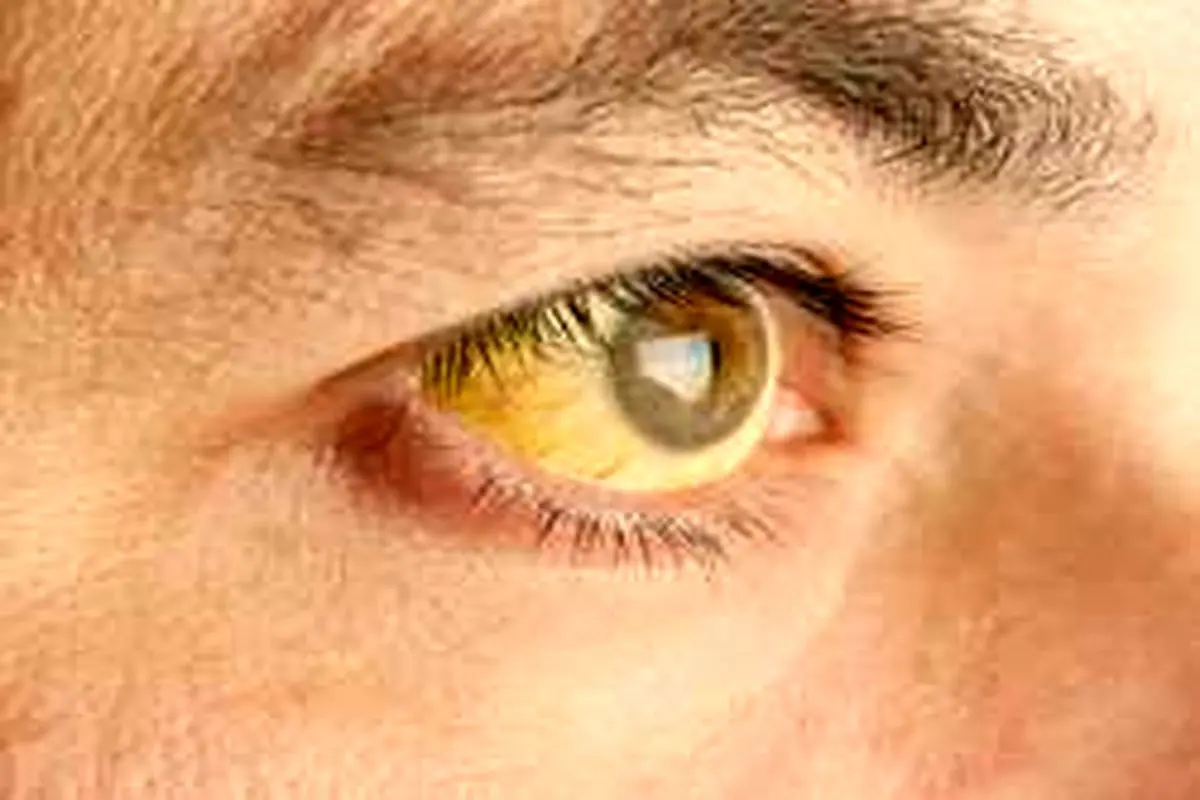 زردی چشم کی خطرناک می‌شود؟