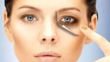 سیاهی زیر چشم و راه‌های درمان آن