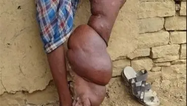 بیماری عجیب نوجوان هندی +عکس