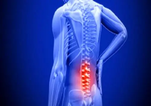 روش‌های سریع برای کاهش درد سیاتیک

