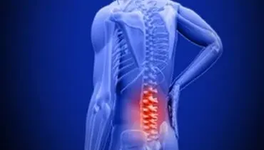 پیاده روی برای مبتلایان به سیاتیک، خوب است؟