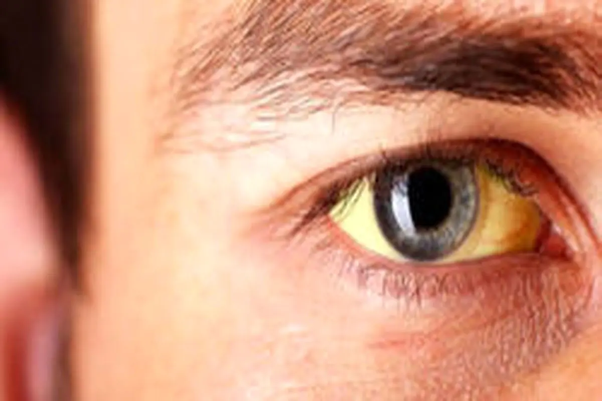 عوارض احتمالی زردی چشم چیست؟