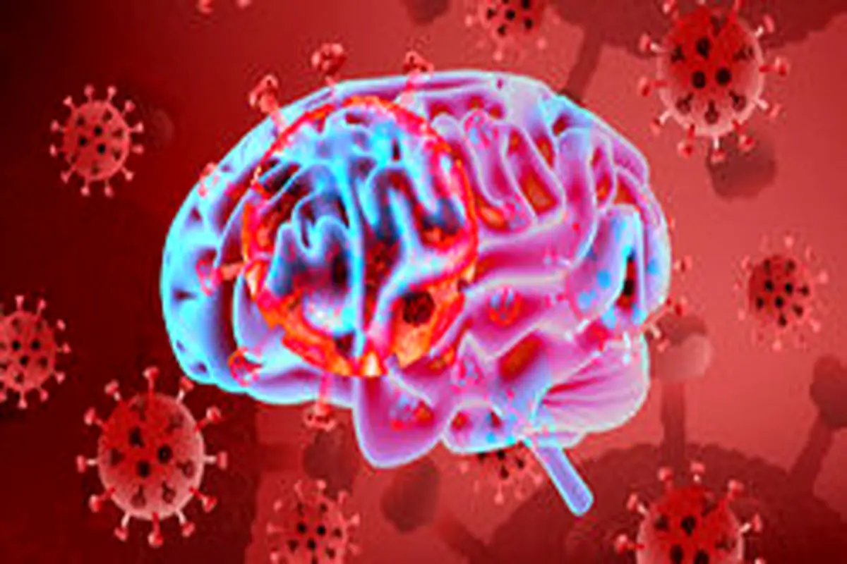 بیماری کووید ۱۹ با نشانه سکته مغزی ظاهر می‌شود