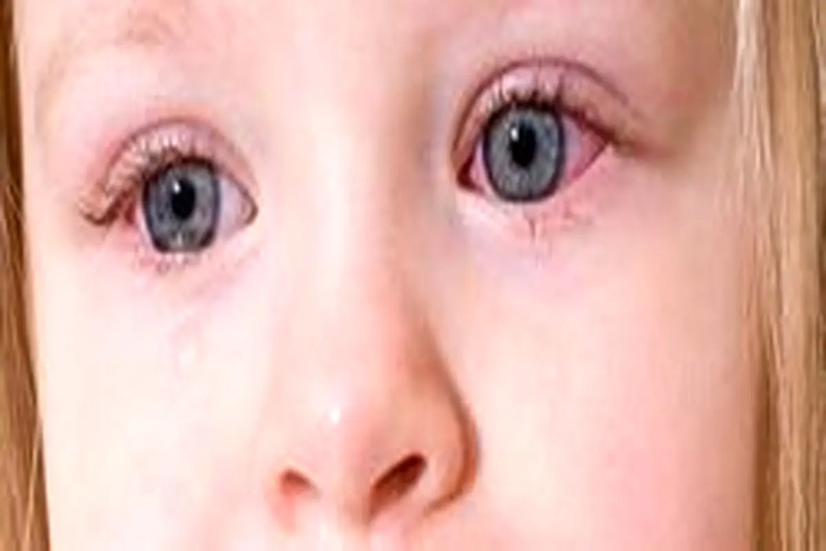 سرما خوردگی چشم چه علائمی دارد؟