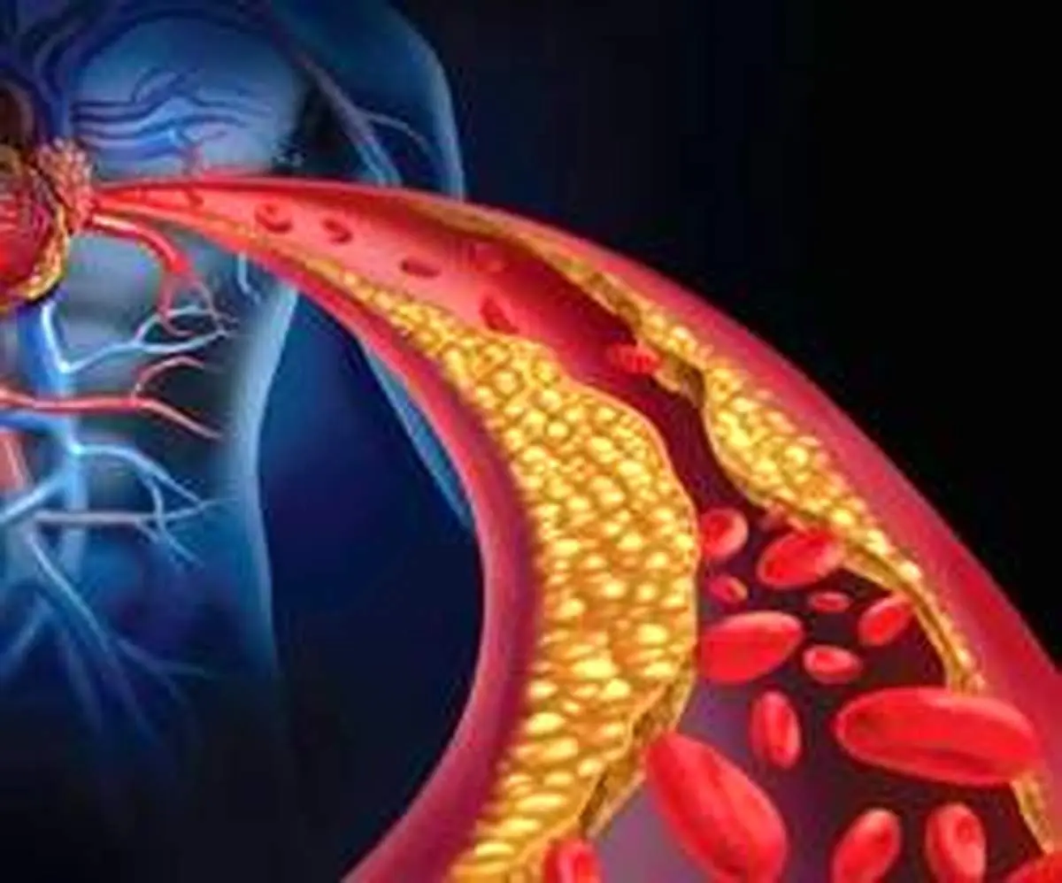 کاهش چربی خون با چند راهکار ساده