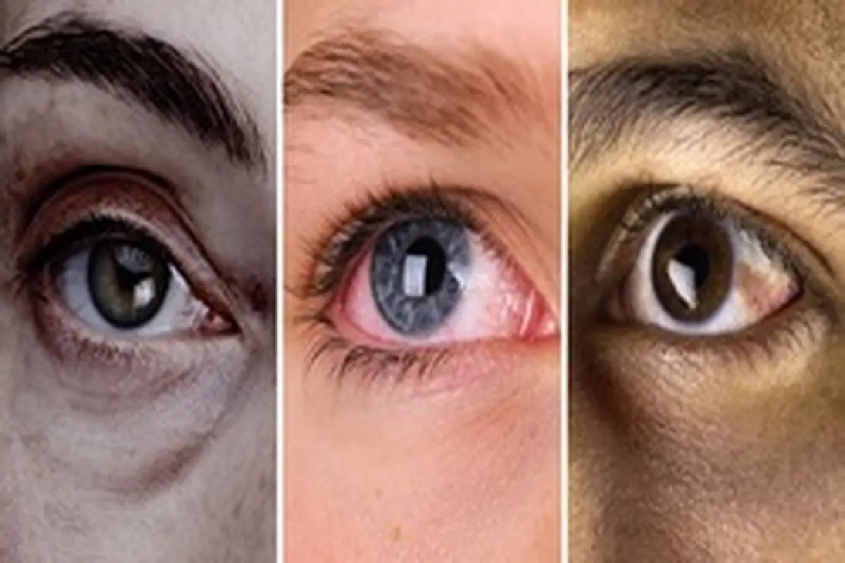آشنایی با بیماری های چشمی/ علت بیرون زدگی چشم‌ها چیست؟