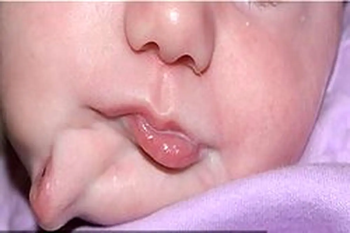 عکس/نوزادی با دو دهان متولد شد/ جراحی موفقیت آمیز دهان اضافه
